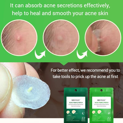 Tea Tree Acne Patch Fades Acne Marks and Ultra-thin