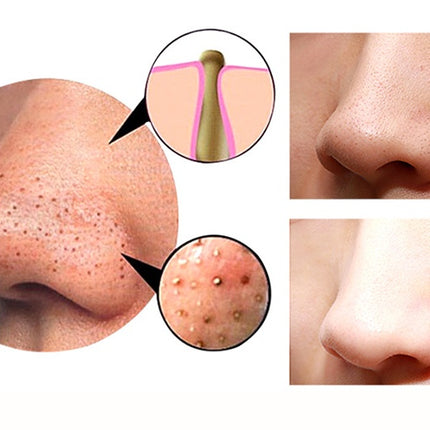 4 in 1 Body Guasha Cupping Blackhead Remover Machine Facial Pore Deep Cleansing Beauty Skin Care