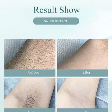 Laser hair removal equipment