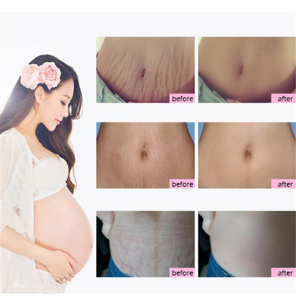 Natuurlike Sagte Nie-irriterende Mango Rekmerke Verwyderaar Room Vir Swangerskap Herstel Litteken Verslapping Lyne Abdomen Rekmerke Room