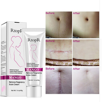 Natuurlike Sagte Nie-irriterende Mango Rekmerke Verwyderaar Room Vir Swangerskap Herstel Litteken Verslapping Lyne Abdomen Rekmerke Room