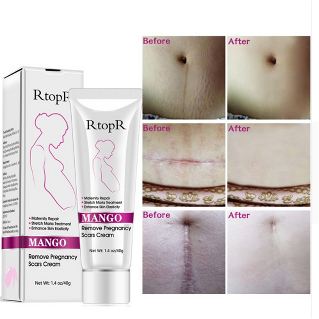 Natuurlike Sagte Nie-irriterende Mango Rekmerke Verwyderaar Room Vir Swangerskap Herstel Litteken Verslapping Lyne Abdomen Rekmerke Room