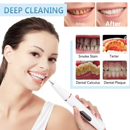 Smart Ultra-Sonic Teeth Cleaner